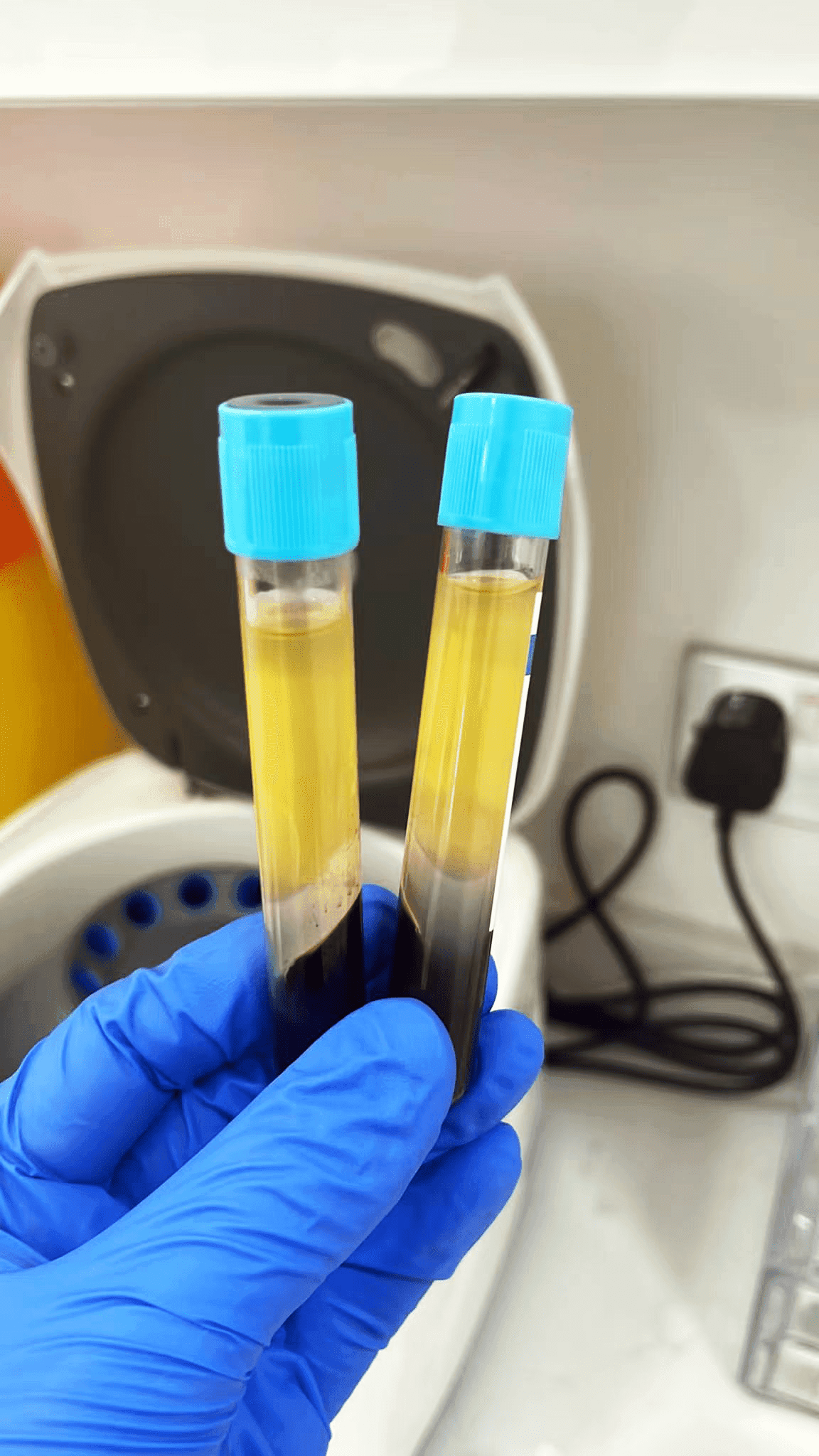 PRP EXTRACTION-after-centrifuge