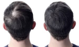 before-and-after-Biotinoyl-Tripeptide-1-