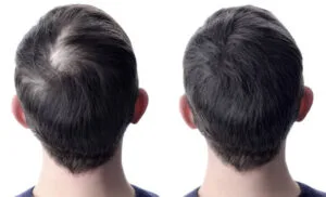before-and-after-Biotinoyl-Tripeptide-1-