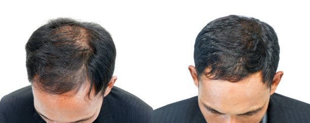 before-and-after-Biotinoyl-Tripeptide-1