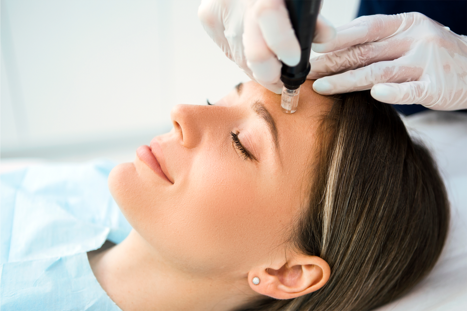 Microneedling-ippocare