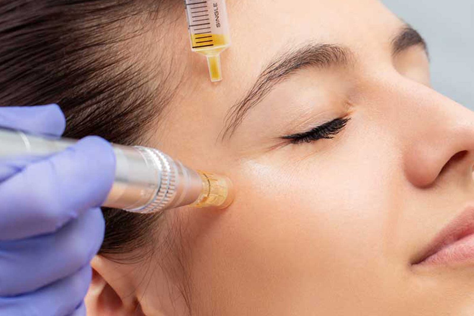 MicroneedlingPRP-ippocare