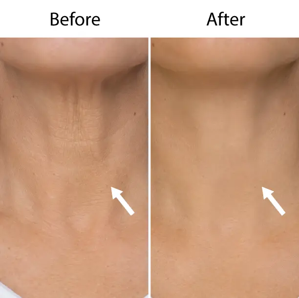 Ultra Fine Hyaluronic Acid Dermal Filler for Neck Lines - Image 5