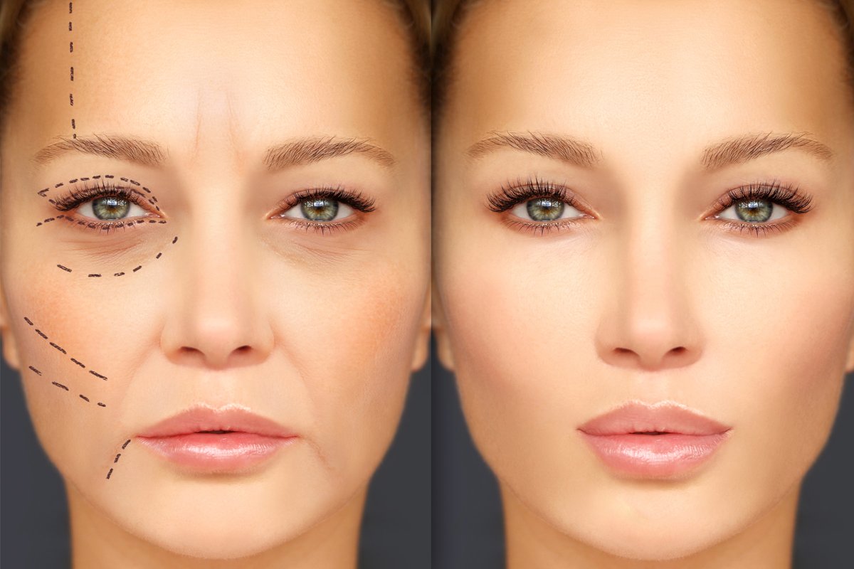 what ha filler help-ippocare