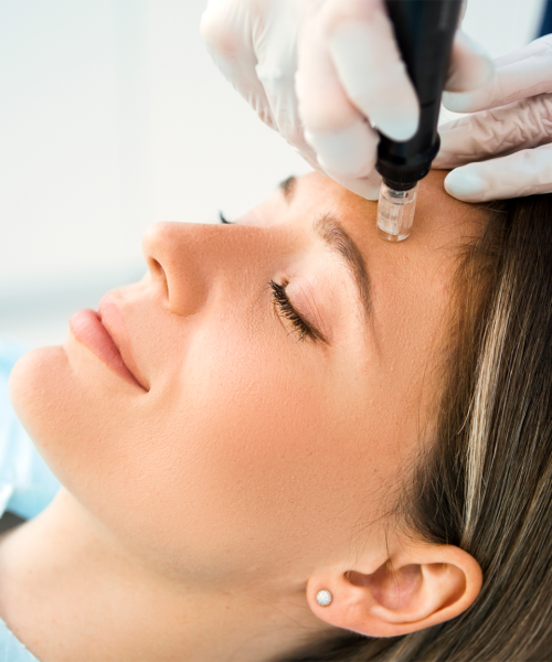 Microneedling-ippocare