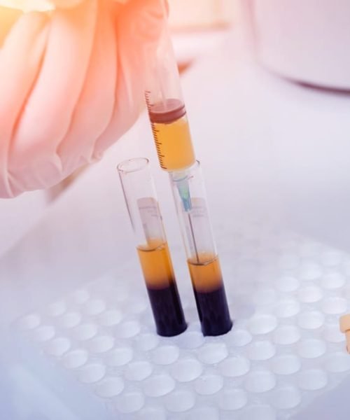 Platelet-Rich plasma-in syringe