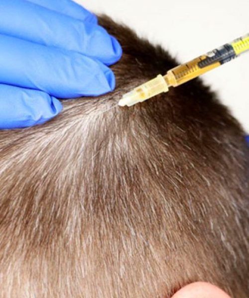 PRP Treatment for Hair Loss