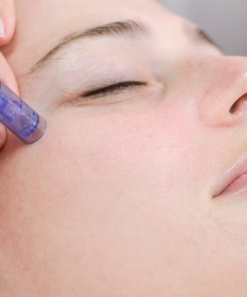 microneedling+HA_ippocare
